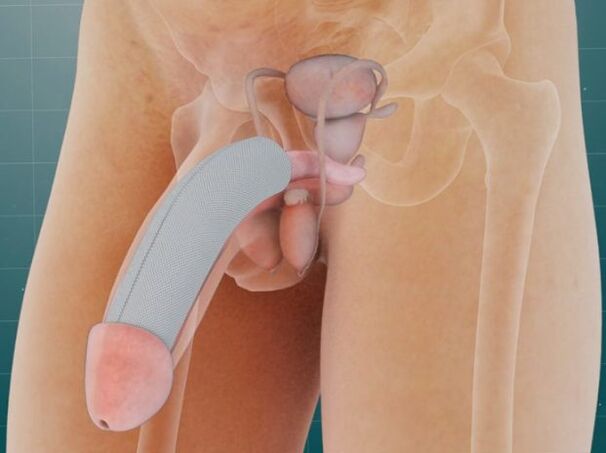 Der Penis nach dem Einbringen eines speziellen Implantats unter die Haut. 