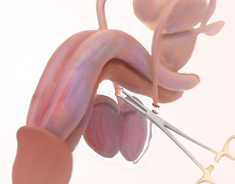 Ligamentotomie zur Vergrößerung des Penis