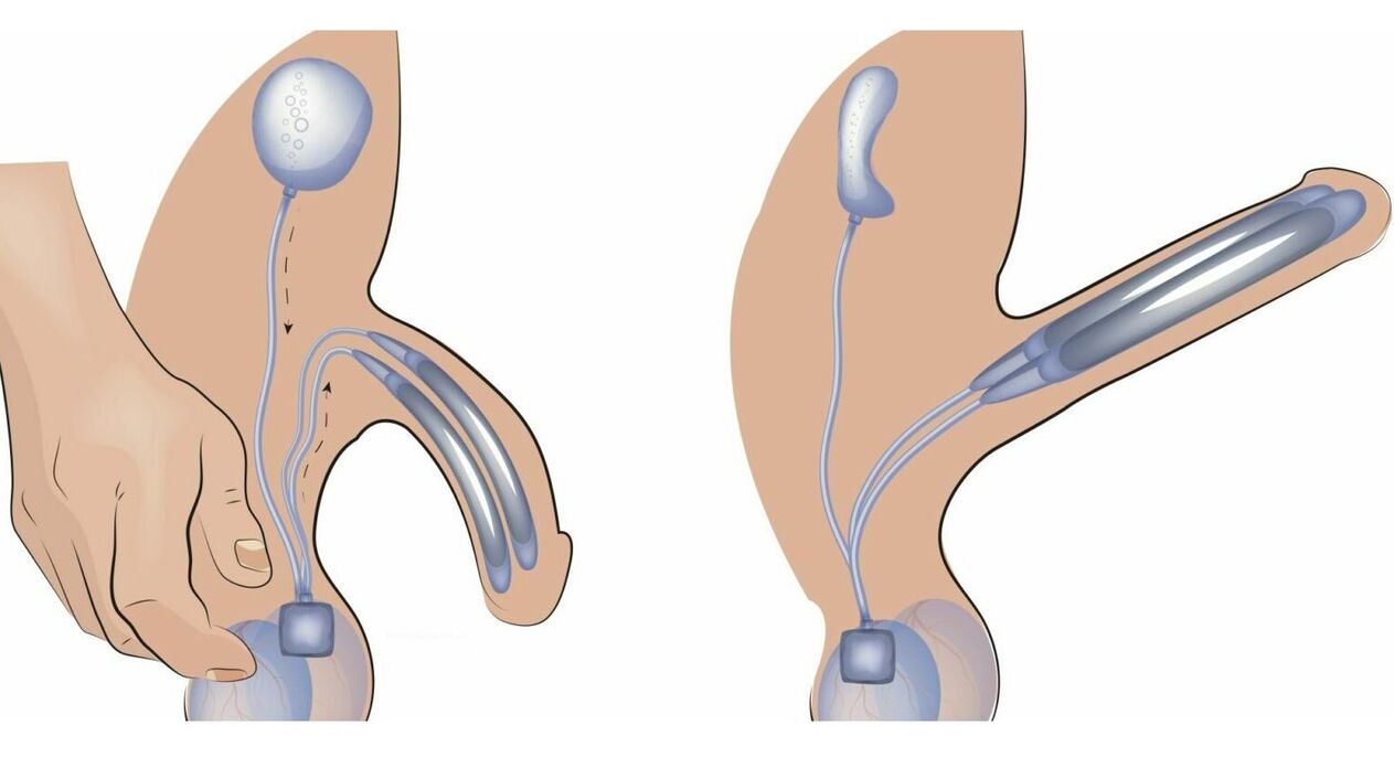 Penisprothese zur Vergrößerung des Penis